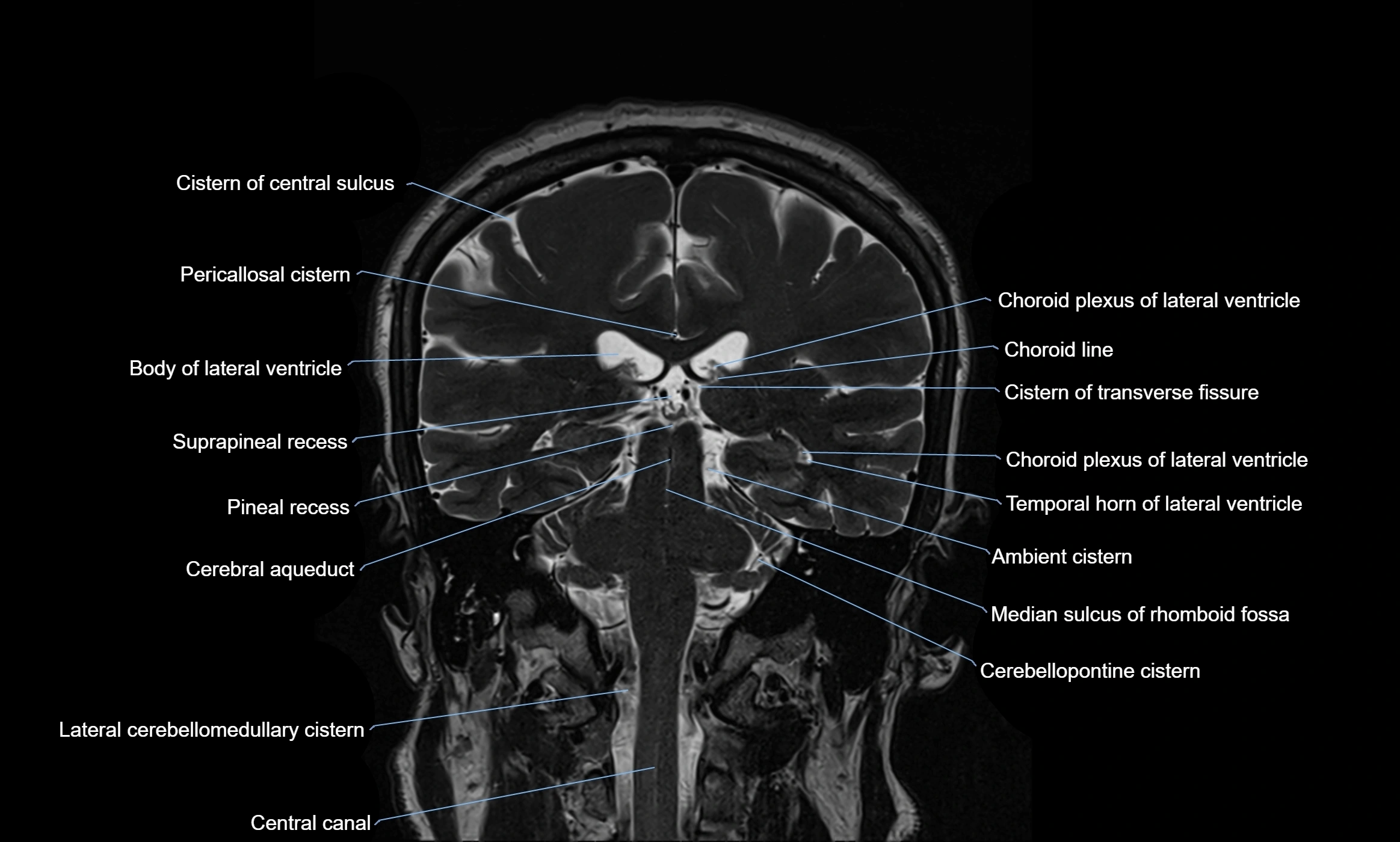 Brain cisterns  and ventricles coronal anatomy 3T MRI image-img-00001-00037.webp